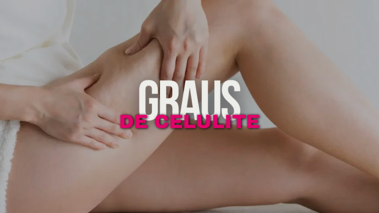 Entendendo os Graus da Celulite: Um Guia para Esteticistas e Massoterapeutas