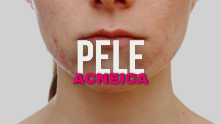 Quais os melhores tratamentos para a pele acneica?