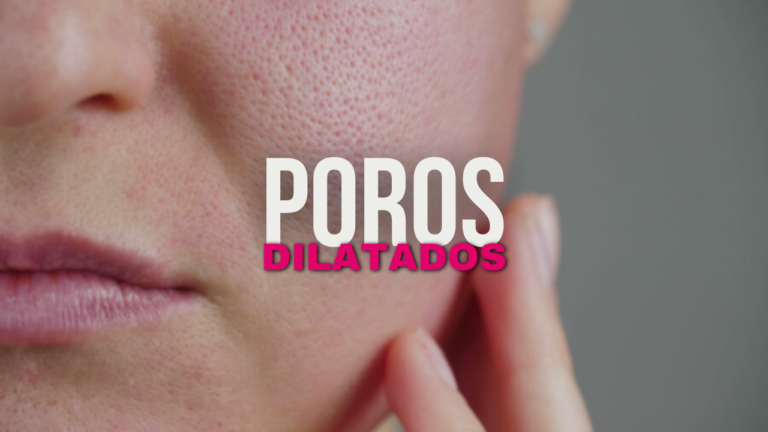 Como realizar tratamentos eficazes para poros dilatados?