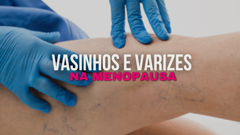 Tratamentos Estéticos para Reduzir a Aparência de Vasinhos e Varizes