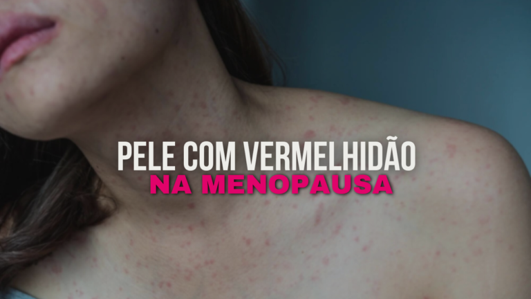 Como Tratar a Pele com Tendência à Vermelhidão na Menopausa
