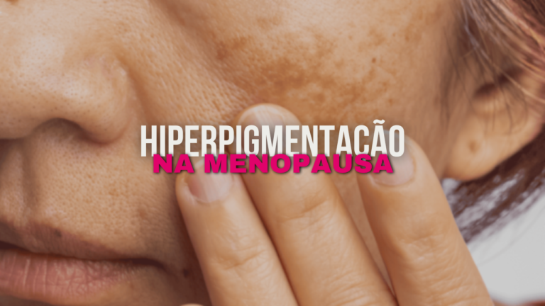 Melhores Opções de Tratamento para Combater a Hiperpigmentação